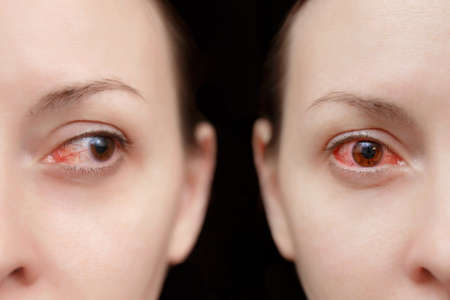 Close up annoyed red blood eyes of female affected by conjunctivitis or after flu, cold, allergy. Looking camera aside. Disease treatment concept. Copy space advertisement. Workspace mockup templateの写真素材
