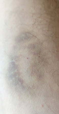Close-up of a bruise on a man's armの写真素材