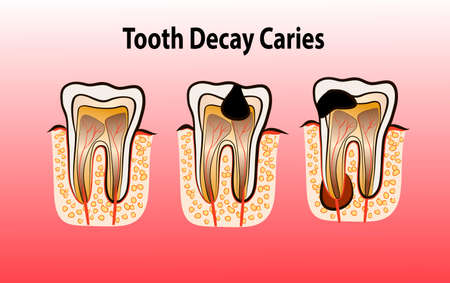 Vector illustration of tooth decay. Four stages of dental caries.のイラスト素材