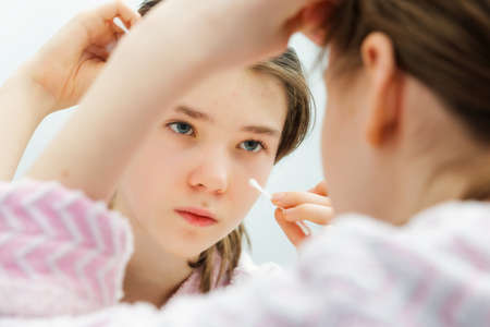 sad teenage girl with acne removing pimples with a cotton swab. problems of transition ageの写真素材