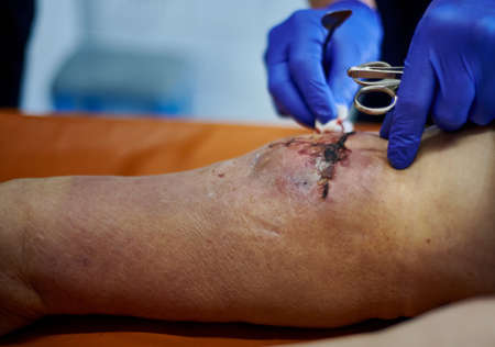 Postoperative wound dressing. Doctor examines the condition of the postoperative wound.の写真素材