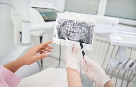 Close-up of dental X-ray in hands of dentist showing the jaw and teeth and discussing with a patient during dental examination, explaining the consultations treatment issues. Diagnostics in dentistryの写真素材