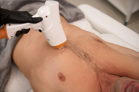 Overhead view of the torso of an athlete man during a hair removal procedure in a laser epilation studio. Laser hair removal for men using a modern ultrasonic hair removal machine. Male waxingの写真素材