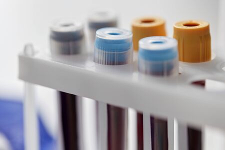 beakers with coronavirus blood test in holder