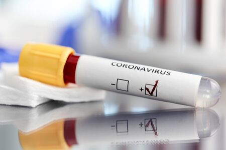 beaker with coronavirus blood test at laboratory