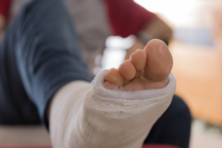 Young man with a broken ankle and a white cast on his leg, sitting on a couch (bokeh)の写真素材