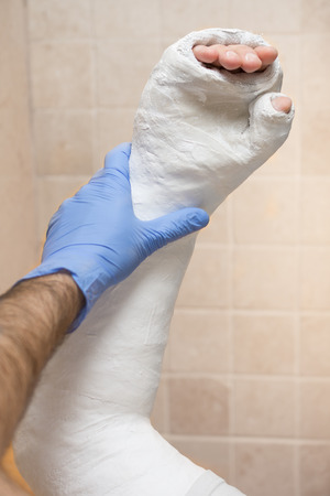 Orthopedic technician putting on a fiberglass / plaster cast on a young man's broken and fractured arm after an injury.  Close up image shows the cast being applied in a clinic / hospital.の写真素材