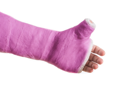 Close up of a pink arm plaster / fiberglass cast  with the thumb extended in a thumbs-up shape, isolated on whiteの写真素材