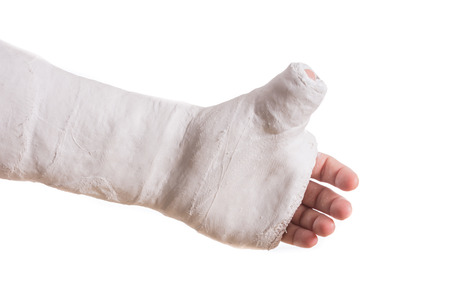 Close up of a white arm plaster / fiberglass cast  with the thumb extended in a thumbs-up shape, isolated on whiteの写真素材