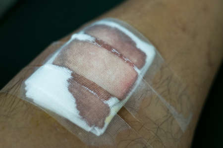 stitching woundsの写真素材