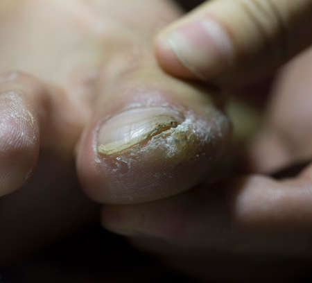 Dirty male fingers on the foot of a macroの写真素材