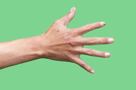 hand of a man with a scar isolated on a green backgroundの写真素材