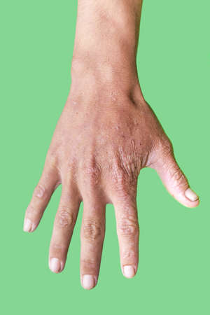 hand of a man with a scar isolated on a green background