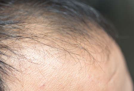 A middle-aged man with hair loss. Baldness