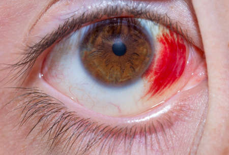 hematoma in the eyes of macro