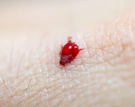 Blood on the skin from a cut with a knife