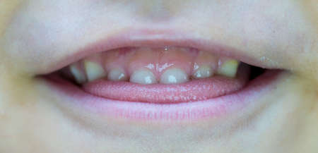 Six-year-old boy smiles, showing calf's teeth, mouth macro close-upの写真素材