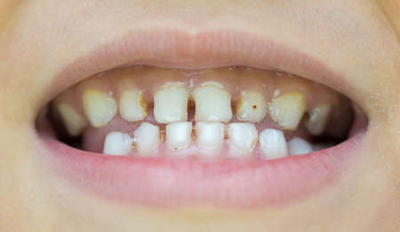 Six-year-old boy smiles, showing calf's teeth, mouth macro close-upの写真素材