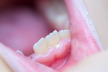 Six-year-old boy smiles, showing calf's teeth, mouth macro close-upの写真素材