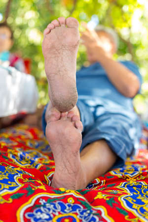 man with dry skin on heelsの写真素材