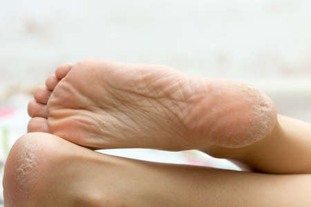 dry dehydrated skin on the heels of female legsの写真素材