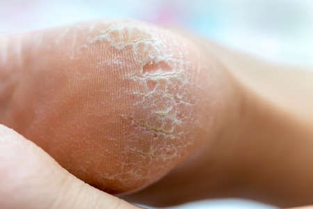 dry dehydrated skin on the heels of female legsの写真素材