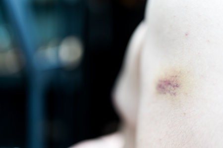 Close up purple bruise on the arm of human from accident.