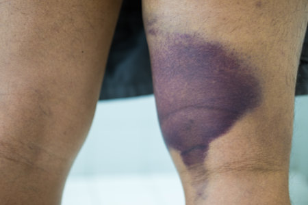 Great bruise on man leg, close upの写真素材