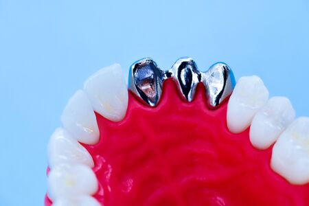Teeth implant and crown installation process isolated on a blue background. Medically accurate 3D illustrationの写真素材