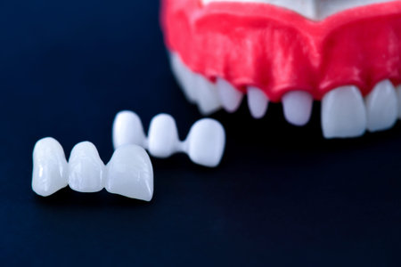 Teeth implant and crown installation process isolated on a blue background. Medically accurate 3D...
