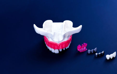 Teeth implant and crown installation process isolated on a blue background. Medically accurate 3D...