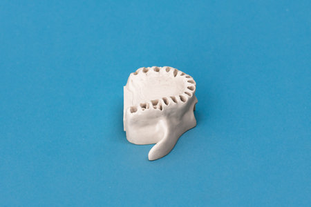 Upper human jaw without teeth model medical implant isolated on blue background. Healthy teeth,...