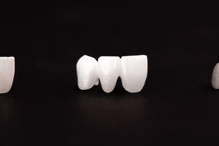 Teeth implant and crown installation process parts isolated on a black background. Medically...