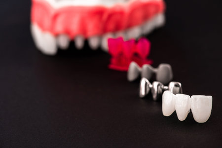 Teeth implant and crown installation process parts isolated on a blue background. Medically accurate...