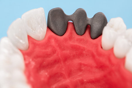 Teeth implant and crown installation process parts isolated on a blue background. Medically accurate...