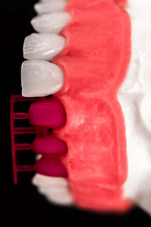 Teeth implant and crown installation process parts isolated on a blue background. Medically accurate 3D model.の写真素材