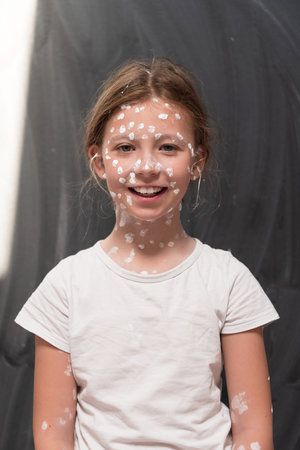 Portrait of a little school girl with chickenpox, antiseptic cream applied to face and body .Chalkboard background.の写真素材