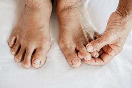 closeup woman feet suffering from joint pain with gout in fingerの写真素材
