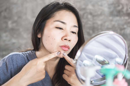 Asian woman having skin problem with acne face ,squeezing pimples with mirrorの写真素材