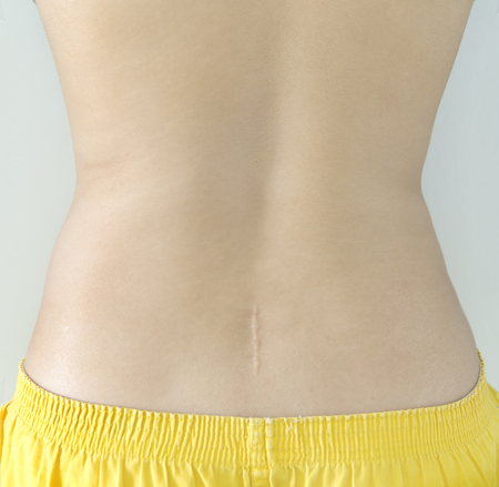 Scar after operation on back of women - back surgery scarの写真素材