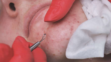 Squeezing acne from a girl with problem skin in the salon using a loop.の写真素材