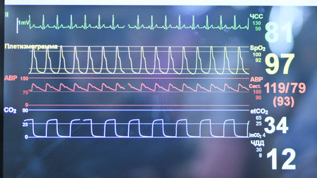 Vital signs display on medical monitor showing ECG, SpO2, and blood pressure waves