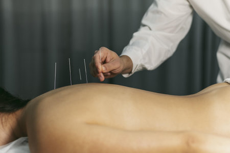 acupuncture process. High quality beautiful photo conceptの写真素材