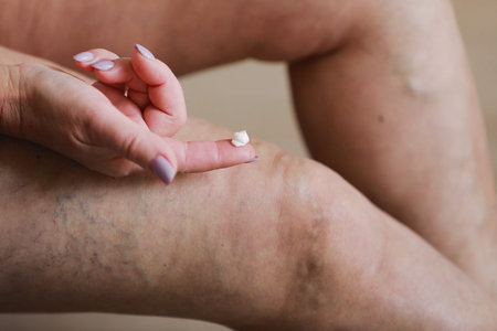 The woman rubs tired legs with a special cream to reduce pain. Phlebology. Painful varicose and...