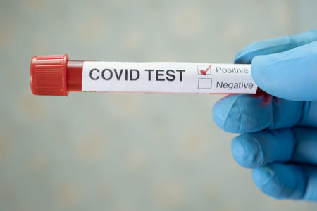 Positive blood infection sample in test tube for covid-19 coronavirus in lab. Scientist holding to...