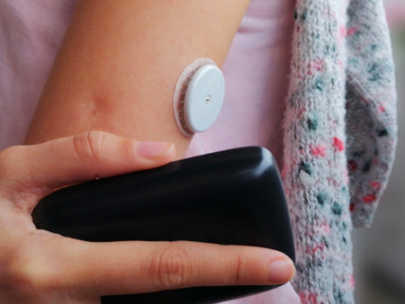 Medical equipment. Closeup white sensor on the arm and device for continuous glucose monitoring -...
