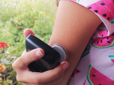 Diabetes type 1. Moment of  reading a glucose levels using device for continuous glucose monitoring...