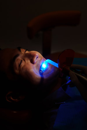 Applying composite fillingの写真素材