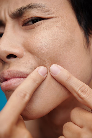 Young man popping pimples on cheeksの写真素材