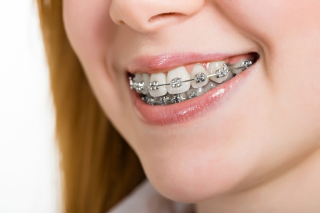 Beautiful young woman with brackets on teeth close upの写真素材